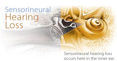 Treatment For Sensorineural Hearing Loss