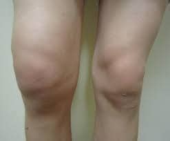 Meniscus Injury: Torn Knee Cartilage