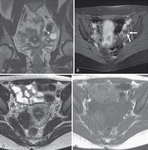 Cystic adnexal lesions | Radiology Key