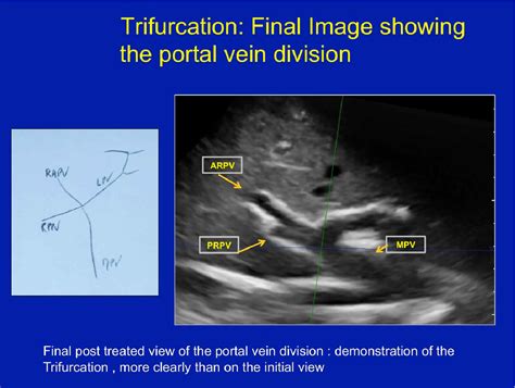 Portal Vein Anatomy Ultrasound