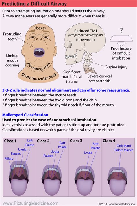 Mallampati Airway Score