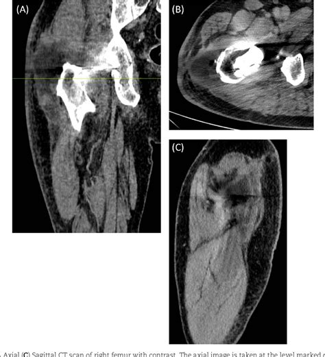 Figure 4 from Kocuria rhizophila prosthetic hip joint infection | Semantic Scholar