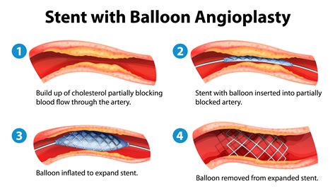 escanear Campo Polar blocked artery in heart stent Lima trolebús arcilla