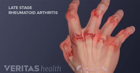 Hand Pain and Rheumatoid Arthritis