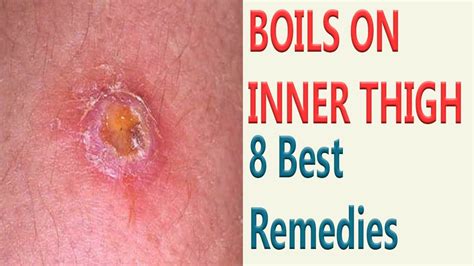 8 Best Remedies To Get Rid Of Boils On Inner Thigh - YouTube