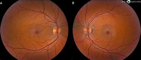 Idiopathic Juxtafoveal Telangiectasia Type II (Macular Telangiectasia type 2) Low Vision, Paper ...