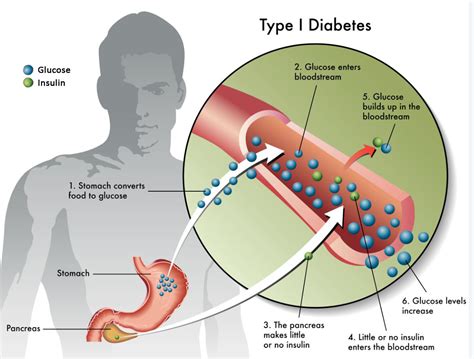 About Diabetes | The Madison Clinic