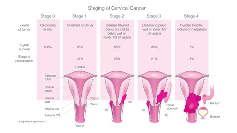 Cervical Cancer | Vagi-Wave