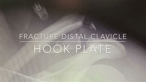 Fracture distal clavicle,ORIF with hook plate - YouTube