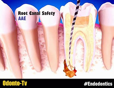 ENDODONTICS: Root Canal Safety - American Association of Endodontists