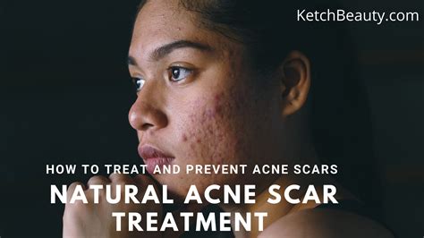 Natural acne scar treatment | How to treat and prevent acne scars ...