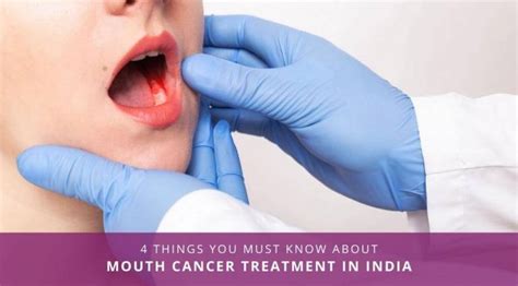 4 Things You Must Know About Mouth Cancer Treatment In India ...