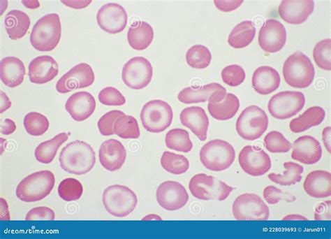 Target Cells With Abnormal Red Blood Cells In Blood Smear Royalty-Free Stock Photo ...