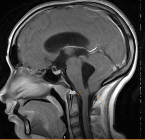 Posterior Fossa Arachnoid Cyst & Tonsillar Descent - Sumer's Radiology Blog