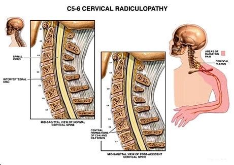 Differentiating Between Cervical Myelopathy and Cervical Radiculopathy ...