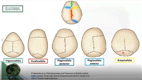 Craneosinostosis segunda parte: Tratamiento - YouTube