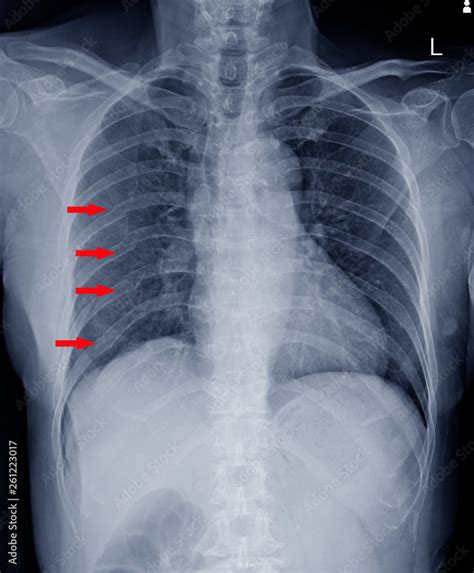 x-ray chest.finding Multiple fracture ribs on red arrows mark. Stock Photo | Adobe Stock