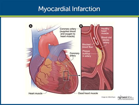 Miyokard İnfarktüsü Nedir? - Sağlığa bir adım