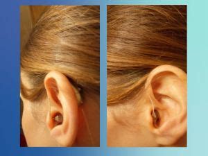 CROS hearing aids for single-sided deafness - My experience