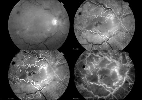 Central Retinal Vein Occlusion (CRVO) Fluorescein Angiography | Wellcome Collection