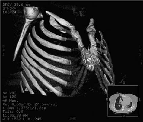 Preoperative chest X-ray. | Download Scientific Diagram