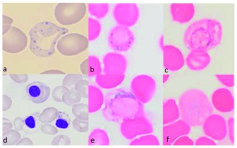 Representative bone marrow smears from a patient treated with ...