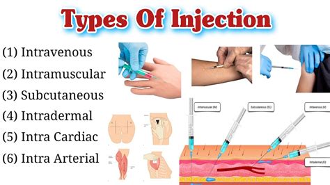 Types Of Injection and Their Site | Route of Injection | Injection ...