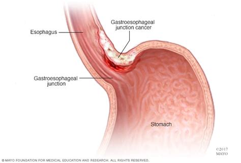 Stomach cancer - Symptoms and causes - Mayo Clinic