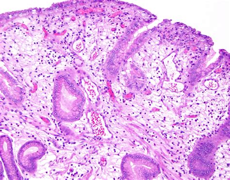 Pathology Outlines - Hyperplastic polyp