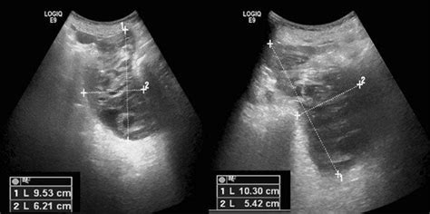 Pelvic hematoma highlighted by abdominal fast ultrasound | Download ...