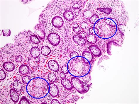 Pathology Outlines - Tactile corpuscle-like bodies