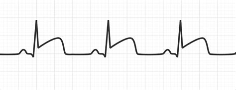 Acute Myocardial Infarction on ECG | ECG Disease Patterns - MedSchool