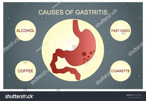 The Main Causes Of Gastritis: Alcohol, Fast Food, Cigarettes, Coffee. Stock Vector Illustration ...