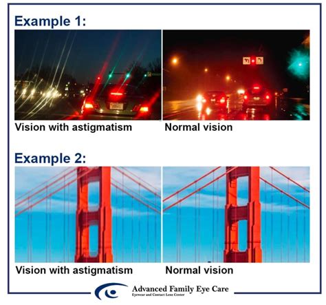 Astigmatism Q&A - Symptoms, Causes, Treatment