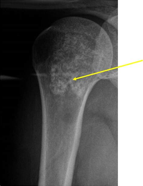 Enchondroma : Benign Bone Tumor: Tumors of Bone