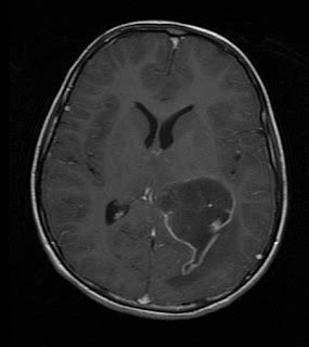 Pilocytic Astrocytoma- MRI Findings - Sumer's Radiology Blog