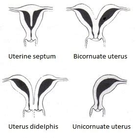 Bicornuate uterus - Wikipedia