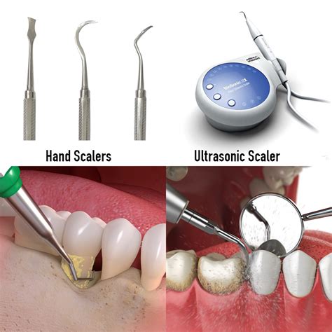 Scaling & Root Planing Treatment in Hyderabad India, FMS Dental