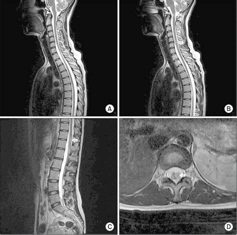 Abnormal Mri Lumbar Spine