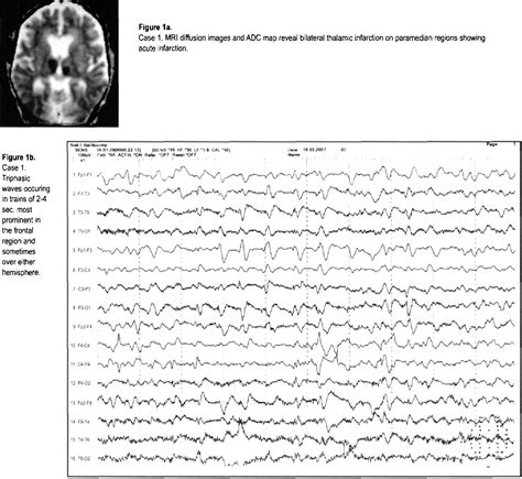 Figure 1 from Triphasic EEG Pattern in Bilateral Paramedian Thalamic Infarction | Semantic Scholar