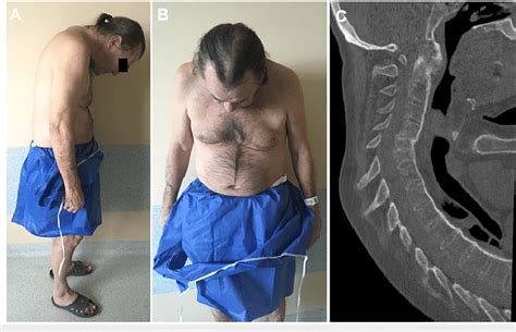 Patient with AS and the chin-on-chest deformity exacerbated by a C5... | Download Scientific Diagram