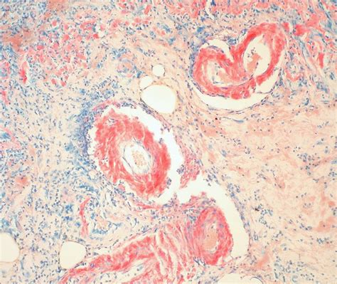 Amyloidosis (Congo Red stain) by Ed Uthman on Flickr Pathology Lab, Red Stain, Microscopy ...