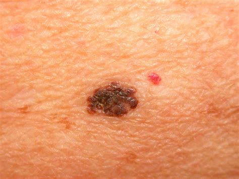 Early-Stage Melanoma: Skin Cancer Treatment