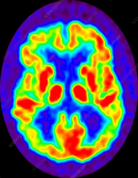 Alzheimer's, PET scan - Stock Image - C039/3545 - Science Photo Library