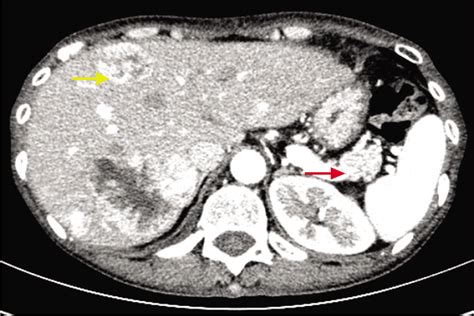 Glucagonoma syndrome with atypical necrolytic migratory erythema - Indian Journal of Dermatology ...