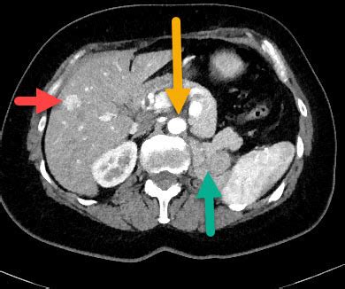 Hypervascular renal cell carcinoma metastasis - Radiology For Beginners by Dr. Samuel Kobba