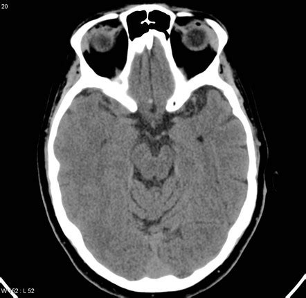 Wallerian degeneration | Radiology Reference Article | Radiopaedia.org