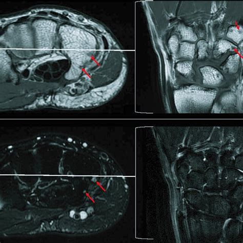 MRI showing T1 hypointense and T2 hyperintense (arrows) 6‐mm lesion in... | Download Scientific ...