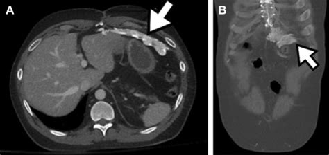 Imaging of Abdominal Postoperative Complications | Radiology Key