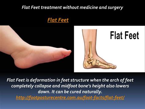 PPT - Flat Feet treatment without medicine and surgery PowerPoint ...